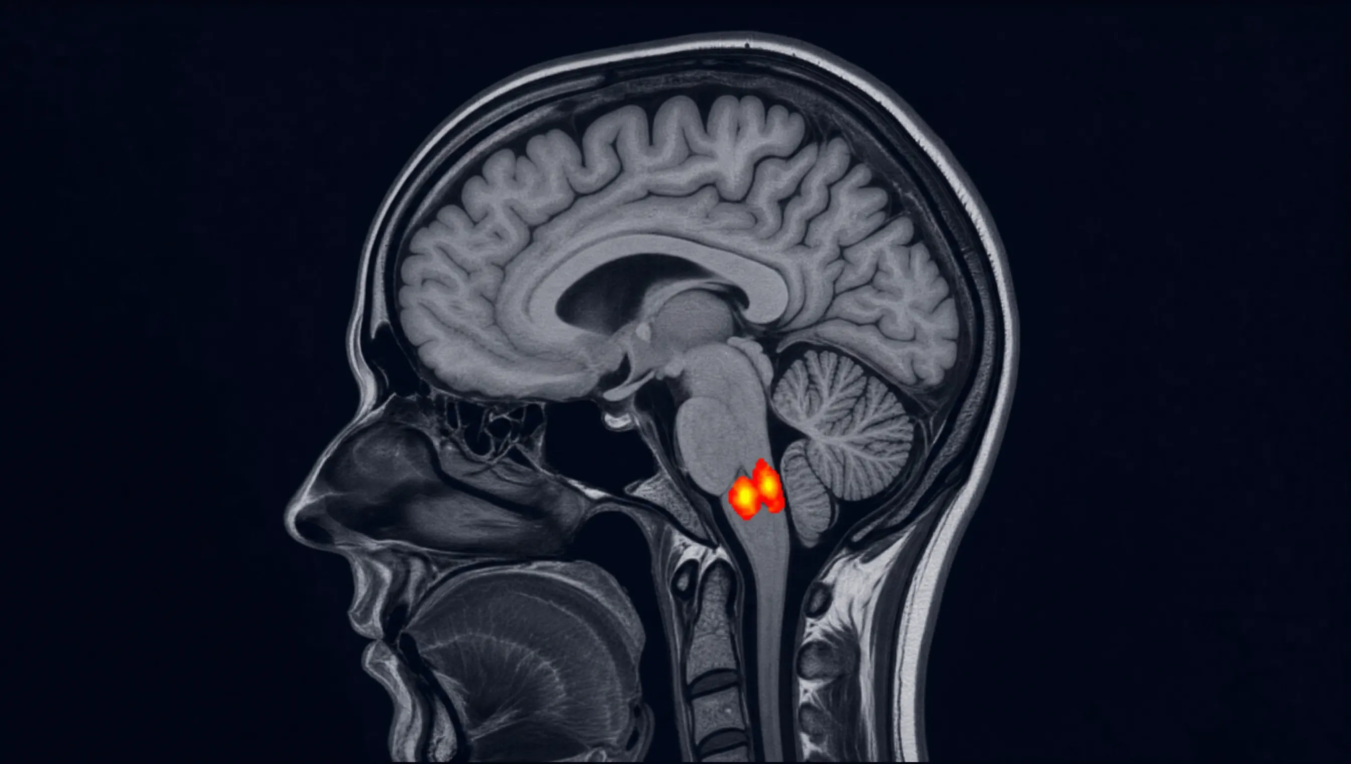 Sagittal fMRI brain scan showing hyperactive DCN region in red and orange at the brainstem